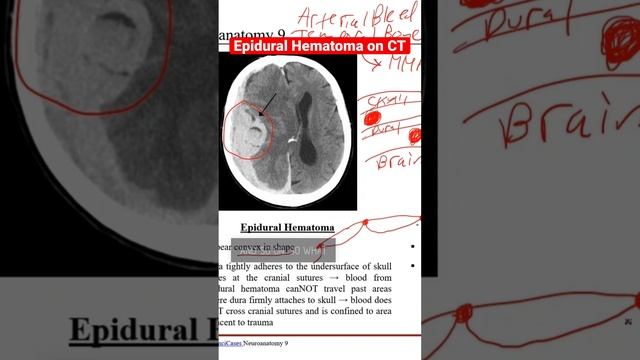 Epidural Hematoma on CT Explained