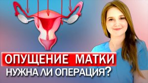 Что делать при опущении матки? ТОП УПРАЖНЕНИЯ