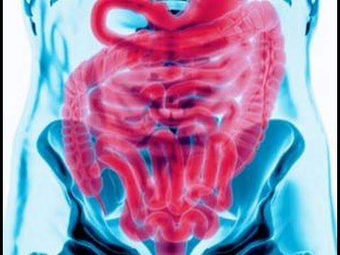 Fecal Transplant Saves Woman's Life смотреть онлайн