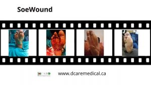 SoeWound The Cutting edge Technology in Wound Healing