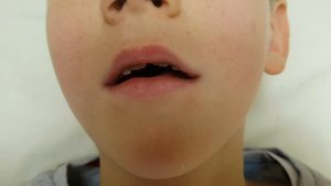 Паретическая форма дизартрии.  "Лошадка" не получается. Что делать? Этап 3