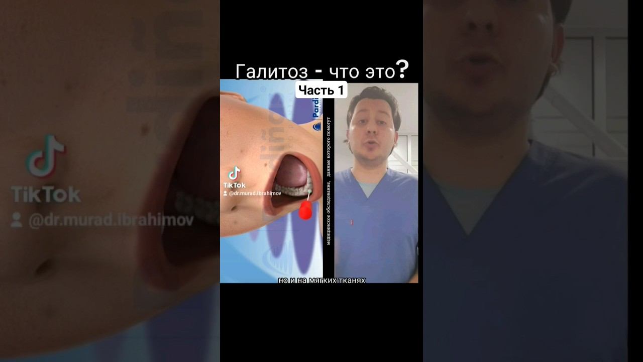 Галитоз - что это? Часть1 #стоматолог #стоматология #гигиенаполостирта #гигиена #запах #зубнойкамен