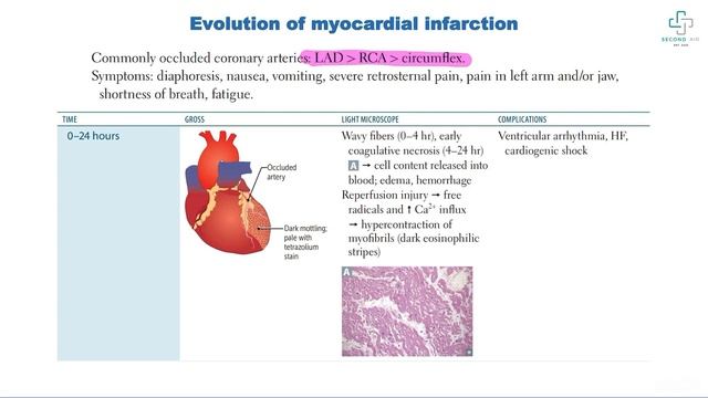 Yurakning ishemik kasalliklari , Stenokardiya , Miokardial infarkt va uning diagnostikasi va asorat смотреть онлайн