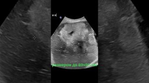 Метастазы в печени на УЗИ.