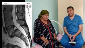 Бел умурткаларини силжиши ва даволашдан кейинги холат (спондилолистез)