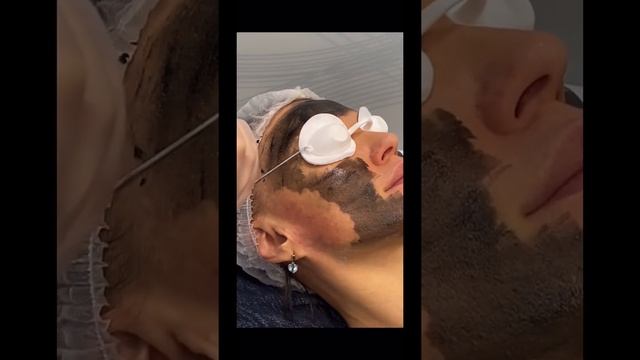 Чистка лица #карбоновыйпилинг#чисткалица