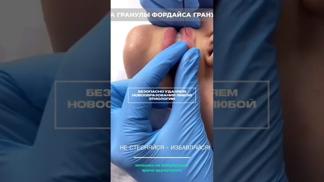 Гранулы фордайса - удаление. #удаление #гранулыфордайса #новообразование #дерматолог #косметолог