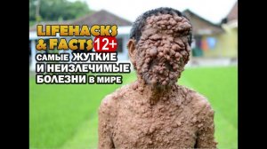 Самые УЖАСНЫЕ и НЕИЗЛЕЧИМЫЕ болезни в мире. От LIFEHACKS&FACTS!