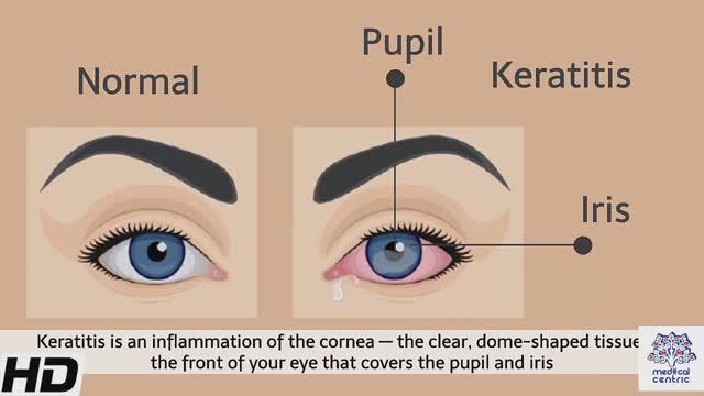 Keratitis. Causes, Signs and Symptoms, Diagnosis and Treatment.