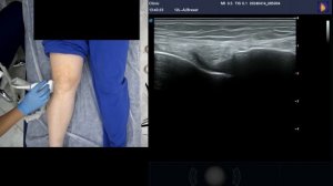 УЗИ коленного сустава