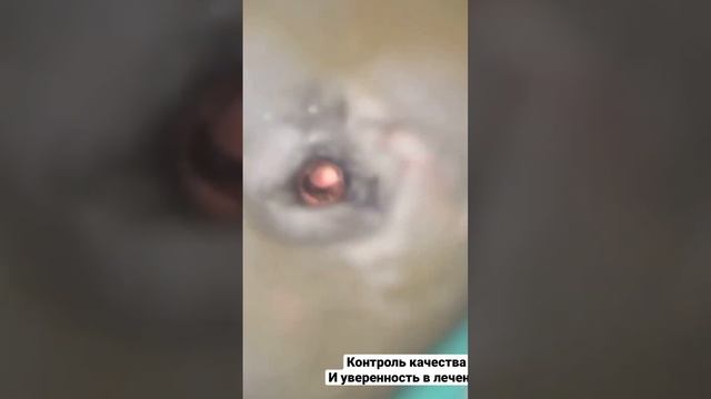 Пломбировка каналов зуба , эндо лечение зубов , виниры , стоматология , Сурайкин Илья