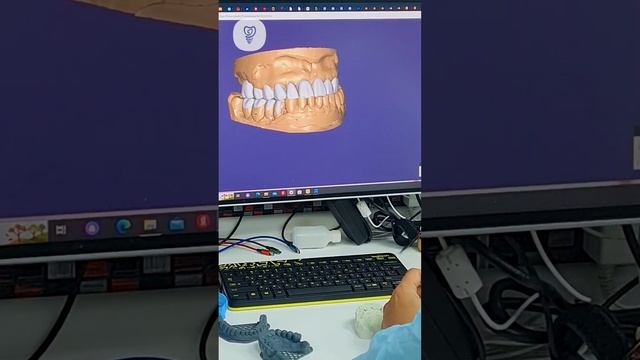 Консультация с пациентом и анализ моделировки зубов. Имплантация зубов.