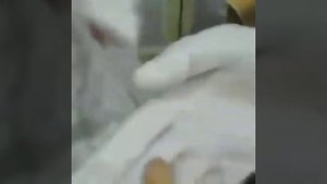 Удаление камней из слюнных желез.