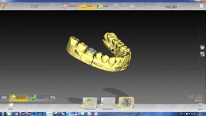 Подгрузка готовой моделировки в inLab15 из ExoCad