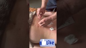 Акупунктурные иглы. Методика установки