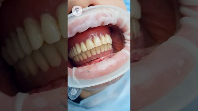 Процесс удаления неразборных имплантатов и установка временных зубов. Имплантация зубов.