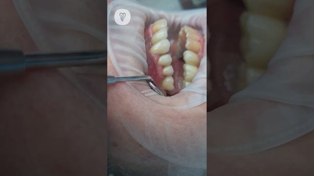 Новый зуб не отличить от своих. Полное прилегание по десне. Имплантация зубов.