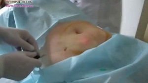 Лазерный липолиз  Лазерная липосакция в Клинике Литус