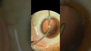 Имплантация торического хрусталика.Позволяет одним этапом избавиться от катаракты и астигматизма.