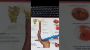 РЕФЛЮКС-ЭЗОФАГИТ. Воспаление пищевода