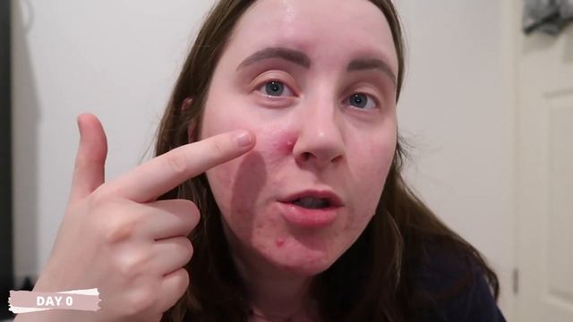 Acne Drying Lotion Vs Spot Sticker | Which One Is Best? смотреть онлайн