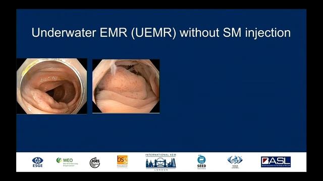 Underwater EMR (UEMR) in the colon смотреть онлайн