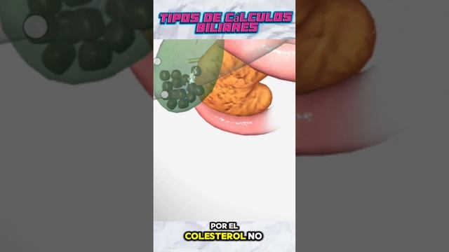 Cálculos Bilirias // Datos que deberías saber sobre los cálculos biliares :) смотреть онлайн