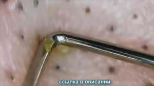 Удаление и выдавливание черных точек и прыщей под микроскопом