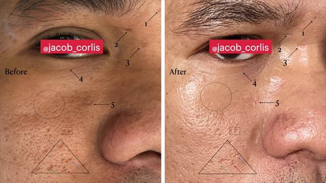 Update Pemakaian byoote setelah 6 box byoote kombinasi some by mi snail truecica смотреть онлайн