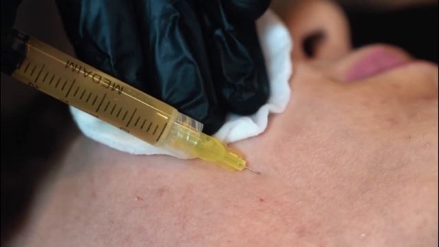 Плазмолифтинг смотреть онлайн