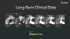 New SuperLine (Higher Strength & Joint Stability) + 2018 Dentium Forum in Thailand
