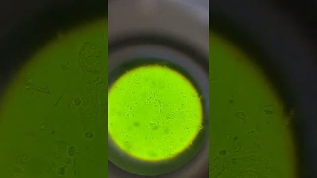 تحليل البول( تحليل الأدرار)  Urine test (GUE ) ما هو تشخيصكم؟