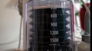 Операция по уменьшению груди. Редукционная маммопластика а также платсика век за одну операцию