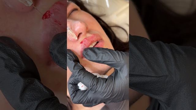 Увеличение губ ( филлер Stilage)  губы 👄