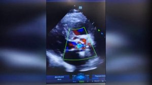 63. Пролабирующая вегетация на створках абцесс ПК синуса и парапротезная фистула.