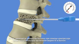 Управляемая баллонная кифопластика МЕДИАМТОМА