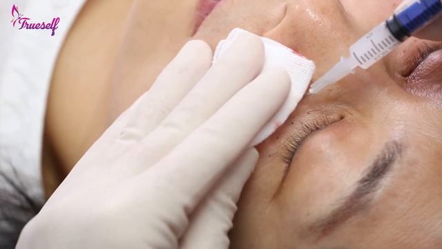 Trueself PLLA dermal filler for cheek