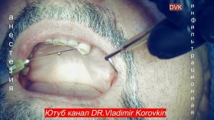 Инфильтрационная анестезия для имплантации область 24, 27.