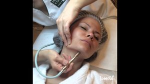 МИКРОДЕРМАБРАЗИЯ