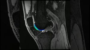 3D T2 mapping in the knee based on DESS