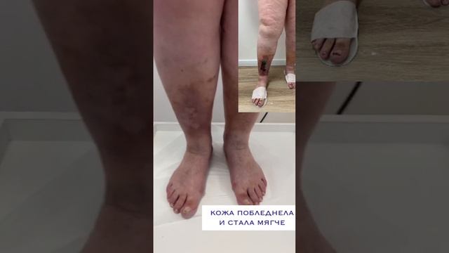 Как мы вылечили трофическую язву и она больше не появляется! Флеболог Якушкин.#трофическаяязва