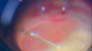 PEC+IOL+vitrectomy+ artificial iris implantation.ФЭК+ витрэктомия+ имплантация искусственной радужк