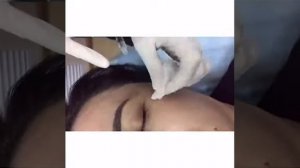 Инъекции ботокса для лица
