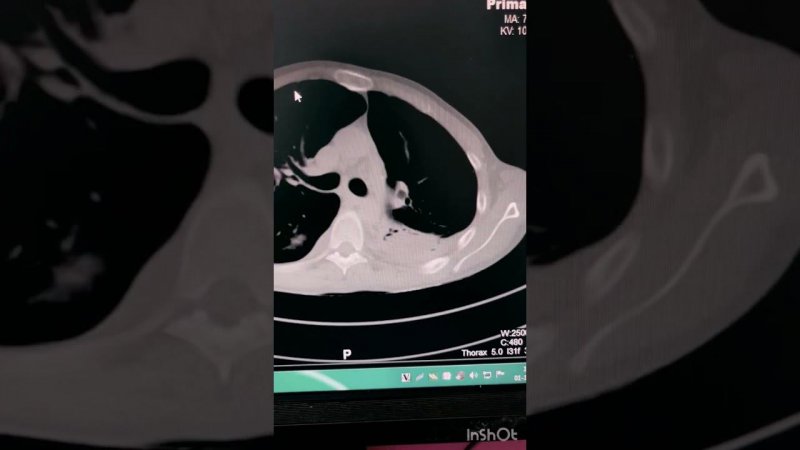 Fungal ball in lungs ||CT thorax || fungal ball thorax || Lung pathologies