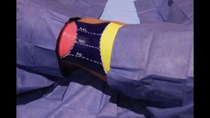 Quadratus Lumborum "QL" Block