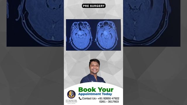 Large pituitary tumors removed with extended anterior endoscopic transsphenoidal surgery #tumors