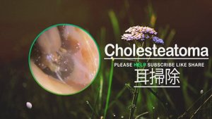 耳垢そうじ , 耳掃除の難聴 最大の耳垢除去[Cholesteatoma] #003