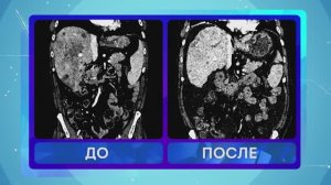 Радиоэмболизация - лечение рака печени / Интервью Лядова Константина Викторовича
