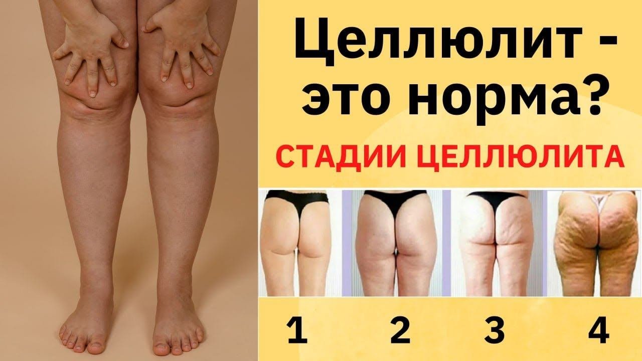 Целлюлит на ногах - это норма? Смотря какая стадия!