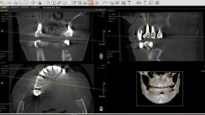 How to change cement fixation to screw / How to Dentist